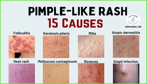 What is a rash that looks like pimples?