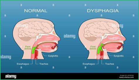 What is Pharyngoesophageal?
